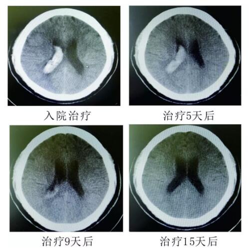腦出血你不得不引起重視的疾?。。?！