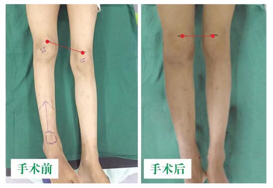 女孩墜梯右腿縮短5cm，幸得醫(yī)生及時診治恢復(fù)正常腿型