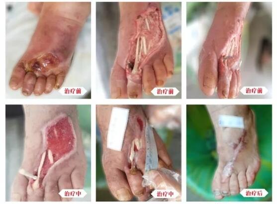 糖尿病并發(fā)癥有多可怕，及時(shí)治療糖尿病足避免截肢！