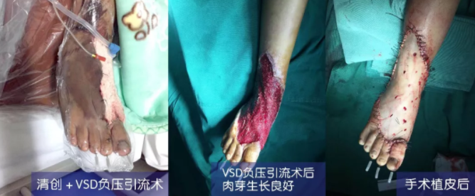 車禍猛如虎，救治如“華佗” ，手術(shù)＋康復(fù)，8歲小女孩車禍后日漸康復(fù)行走
