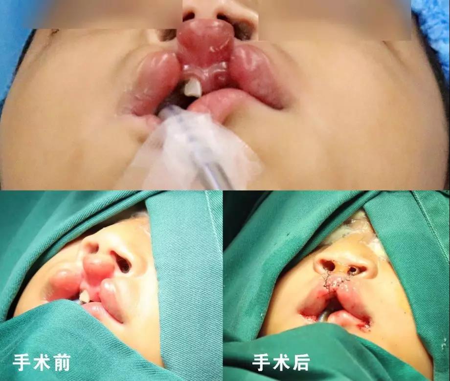 唇腭裂盡早治療消除孩子自卑心理，快樂成長！
