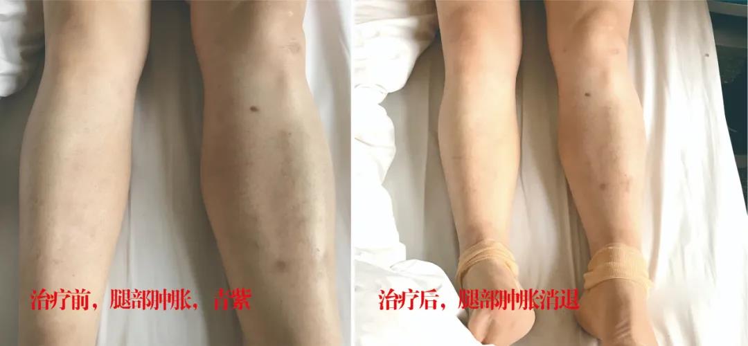 下肢靜脈血栓多年頑疾反復(fù)腫痛——疾病不容等待，早治療，早健康！