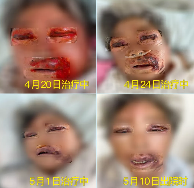 膿毒血癥（急性頜面部蜂窩組織炎）多學(xué)科聯(lián)合會(huì)診，幫助患者成功治愈！