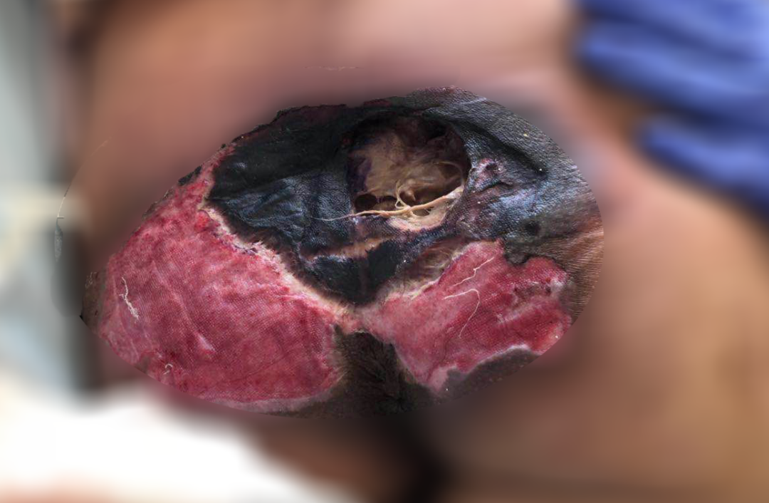 癱瘓3年的女患者臀部居然變成這樣?！