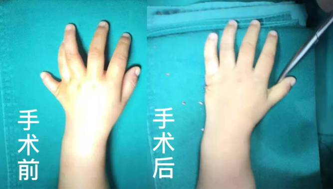 【保山安利醫(yī)院】2歲小兒手、足多指（趾）成功修復(fù)(矯正）！