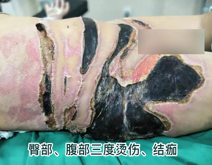【保山安利醫(yī)院】80歲老人不慎燒傷，導(dǎo)致腹部、右側(cè)臀部大面積創(chuàng)傷，經(jīng)植皮治療創(chuàng)面逐漸愈合