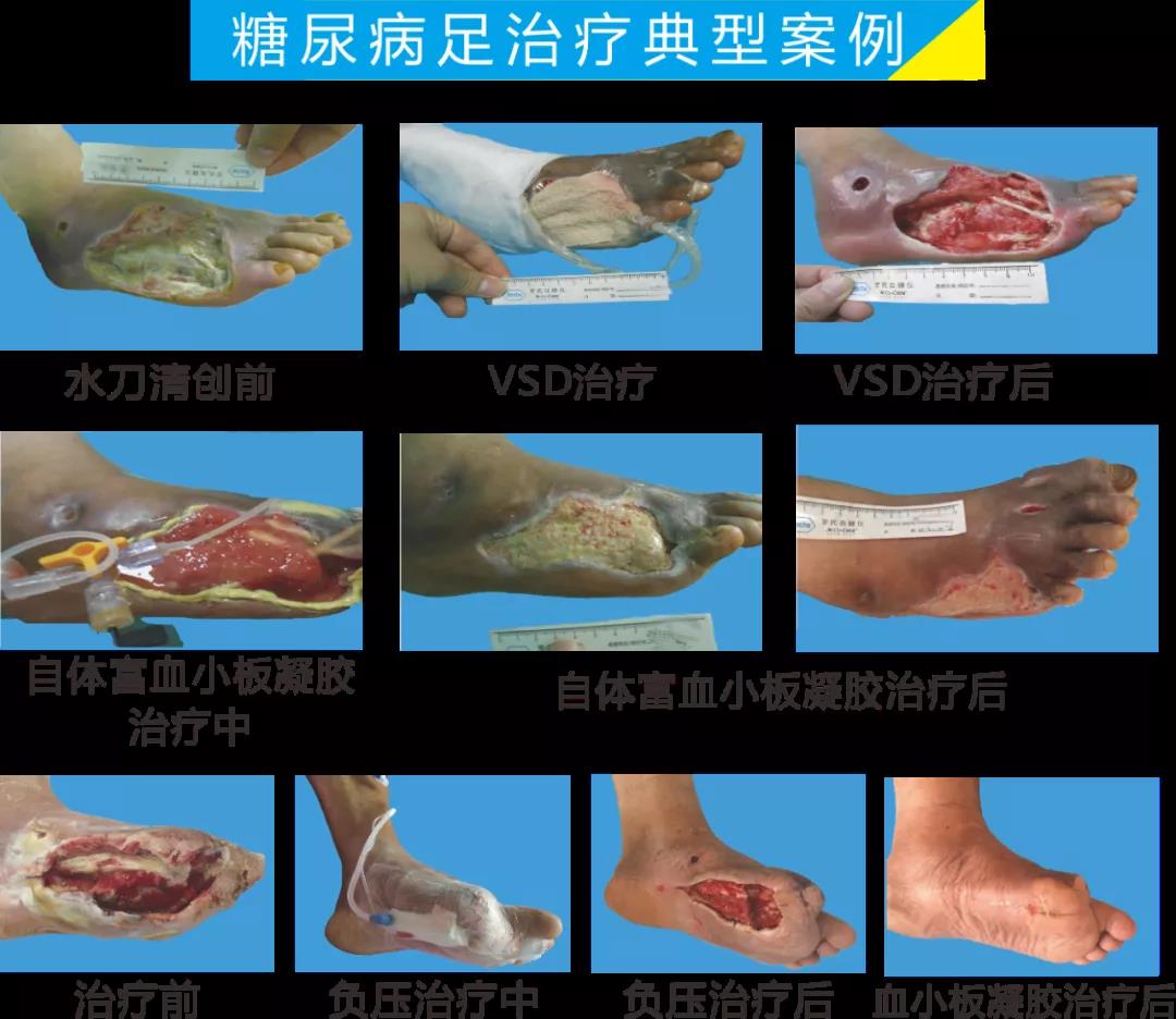 截肢、失明，甚至……，我們要做的是將糖尿病并發(fā)癥遏制在搖籃里！