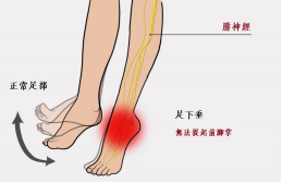 【保山安利醫(yī)院—健康科普】什么是足下垂！你了解嗎？