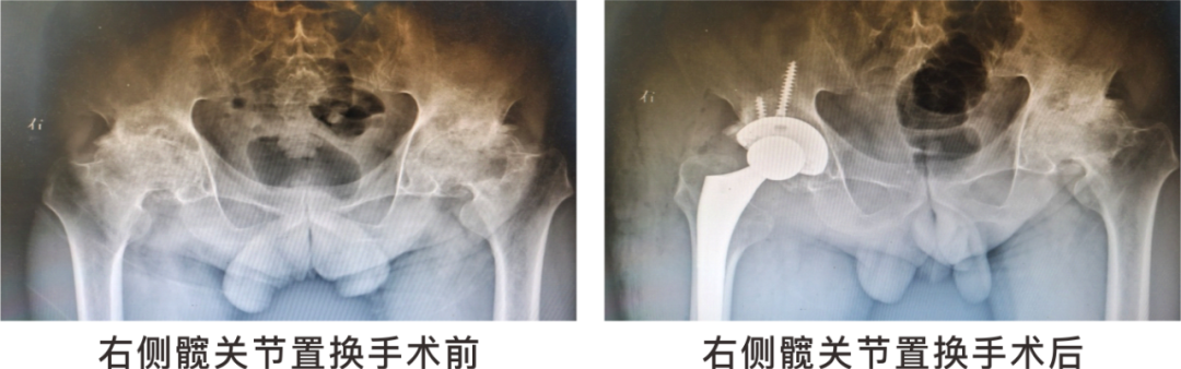 【保山安利醫(yī)院】長(zhǎng)期飲酒導(dǎo)致雙側(cè)股骨頭壞死，髖關(guān)節(jié)置換后重獲運(yùn)動(dòng)功能！